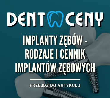 Implanty Zębów - Rodzaje I Cennik Implantów Zębowych